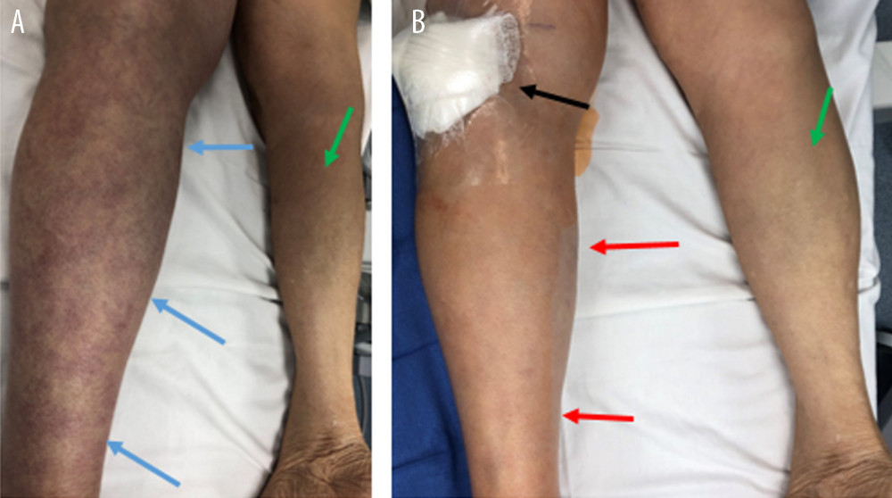 Photographs of patient’s lower extremities in prone position before (A) and after thrombolysis, thrombectomy, and stenting of left iliac vein (B). Note the swelling and skin discolorations over the left calf (reddish alternating with bluish colored areas, blue arrows) due to obstructed venous return and resulting decreased in arterial inflow, representing impeding development of phlegmasia cerulea dolens, when compared to the right leg (green arrows). Complete resolution of the above physical examination findings (red arrows) after left iliac venous endovascular revascularization procedures via left popliteal venous access (black arrow). (Copyright and courtesy of author CI).