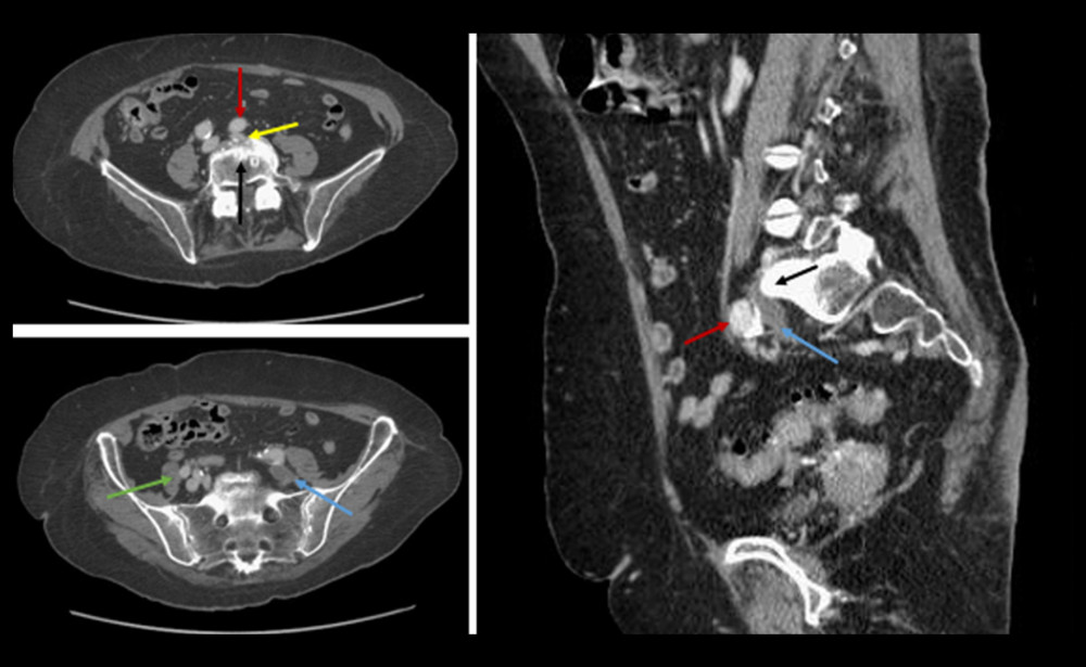 Axial and sagittal pelvic computed tomography venography (CTV) demonstrated left common iliac venous outflow obstruction caused by extrinsic compression of the origin of the left iliac vein (yellow arrow) by the overlying atherosclerotic calcified right common iliac artery (red arrows) crossing against the prominent lumbosacral promontory (black arrow), with resulting thrombosis along the distal left common iliac vein (blue arrows) when compared to patent right common iliac vein (green arrow).