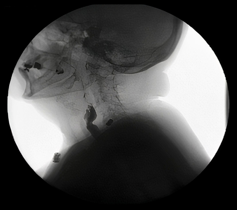 Video fluoroscopic barium swallow revealing distal cervical narrowing.