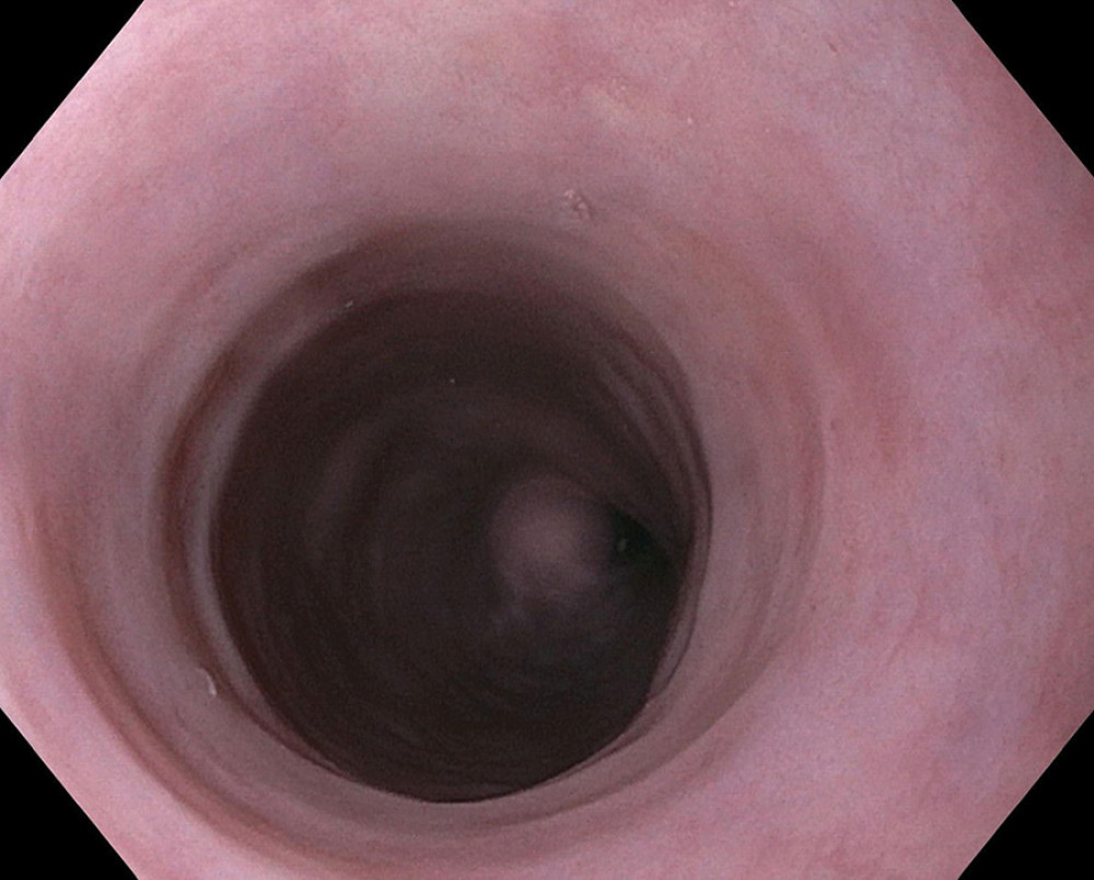 Esophageal web located 18 cm from the incisors.
