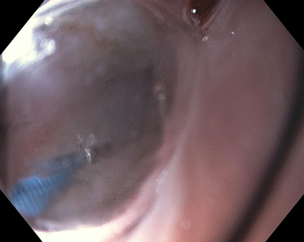 Controlled radial expansion balloon dilation of esophageal web.