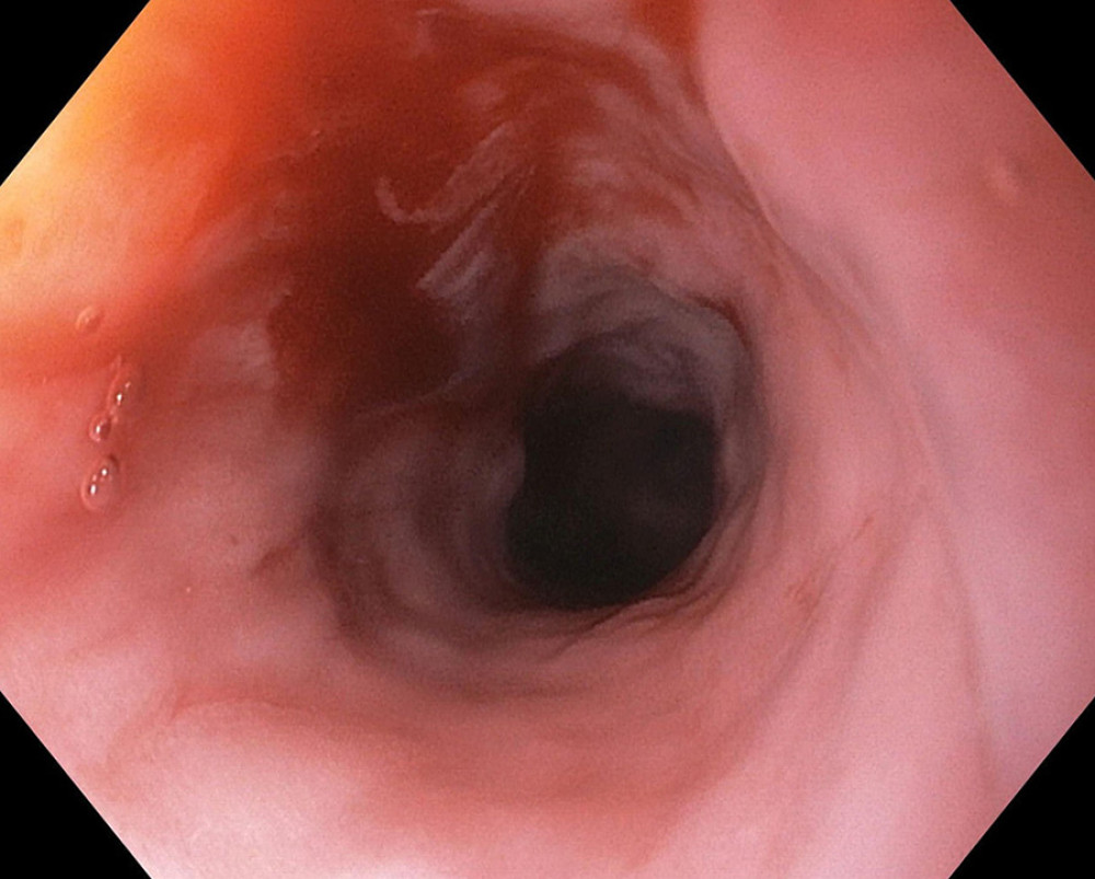 Esophagus after controlled radial expansion balloon dilation revealing resolution of the cervical esophageal web.