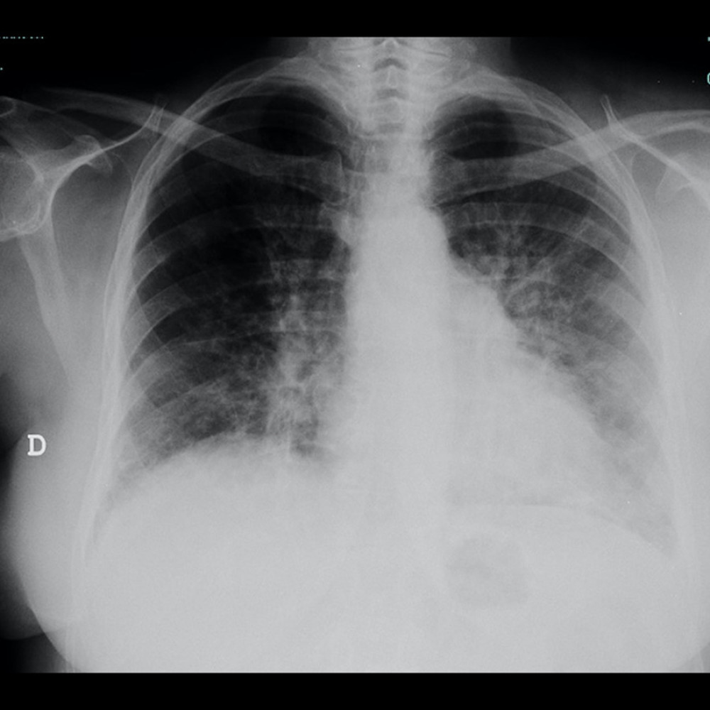 Chest X-ray – lung bases with bilateral interstitial infiltrates.
