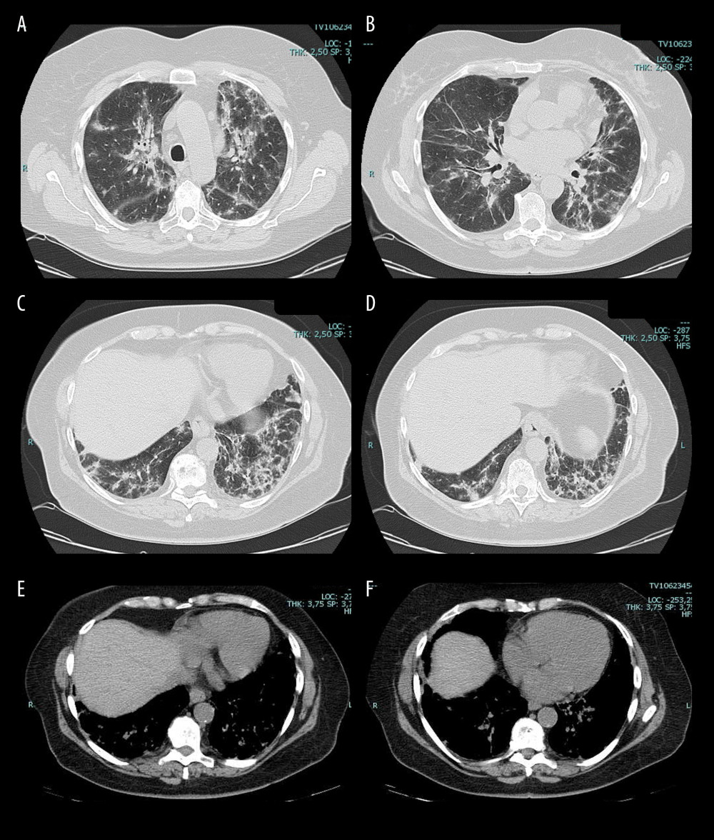 Axial reconstruction of chest HRTC, lung (A–D) and mediastinal (E, F) window: extensive fibrotic areas are observed in both pulmonary fields, predominantly at the base, and pleural thickening, associated retractable bronchiectasis, and with ground-glass opacities.