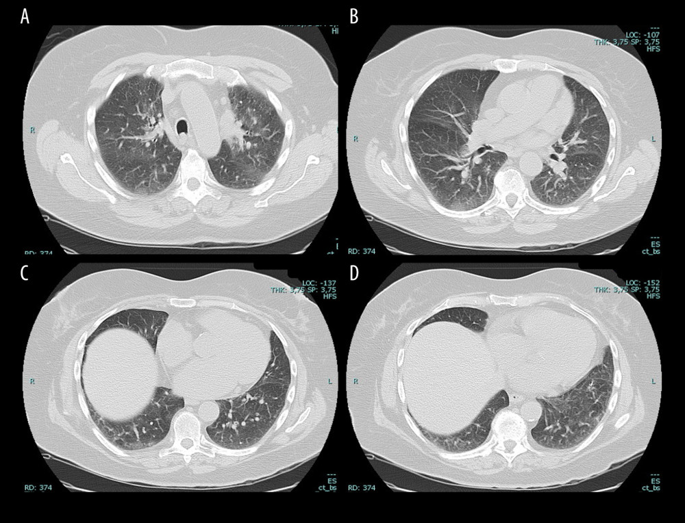 (A–D) Axial reconstruction of chest CT, lung window: evaluation 8 months after drug withdrawal with disappearance of the ground-glass opacities, and resolution of parenchymal and pleural fibrotic changes.