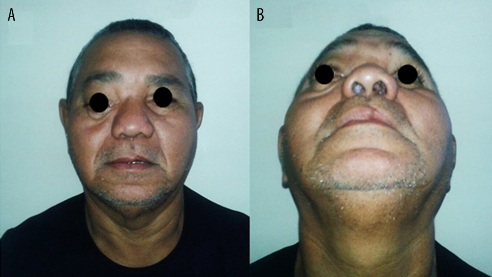 Clinical aspect before the surgical treatment. (A) frontal image showing facial asymmetry and proptosis on the right side. (B) image showing nasal obstruction.