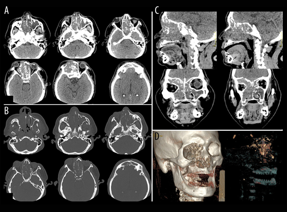 Initial radiographic examinations. CT (axial cross-section). (A) Soft tissue window shows a discreet extension of the lesion to the superficial tissues in the medium bottom from the right orbit. (B) Bone window shows erosion of the bone structure and presence of a continuous solution in the walls of the maxillary sinus, ethmoidal intercellular septum, sphenoidal sinus wall and frontal sinus, notably, in the medium and top walls from the right orbit. (C) CT from sagittal and frontal cross-section: soft tissue window shows extension of the lesion to the paranasal sinuses, the nasal cavity bilaterally, and involvement of the right orbit cavity. (D) Volumetric reconstruction illustrating the tumor extension.