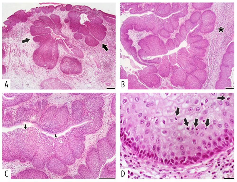 Histopathological exam. (A) Mucosis fragments covered with epithelial keratinized and non-keratinized tissue. Epithelial papillary projections through the adjacent stroma that confers an inverted architecture in relation to the neoplastic epithelium and the presence of continuous cells nests with the epithelial surface (arrows). Scale bar: 200 µm. (B) Stratified epithelial tissue and conjunctive tissue loosely ordered with an inflammatory lymphoplasmacytic infiltrated (asterisk). Scale bar: 200 µm. (C) Stratified squamous keratinized epithelial tissue showing papillary projections of many sizes (arrow). In other area, was observed respiratory epithelium (arrowhead). (D) Presence of hyperchromatic cells, with voluminous nucleus in the epithelium basal and parabasal and koilocytes in the superficial layers (arrows). Scale bar: 20 µm.