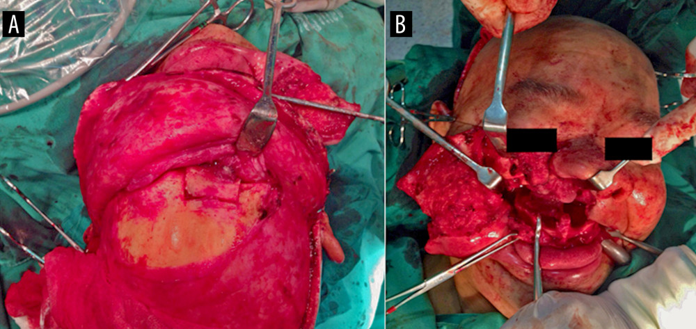 Intraoperative image. (A) Weber-Ferguson’s access with Le Fort I osteotomy. (B) Bicoronal access.