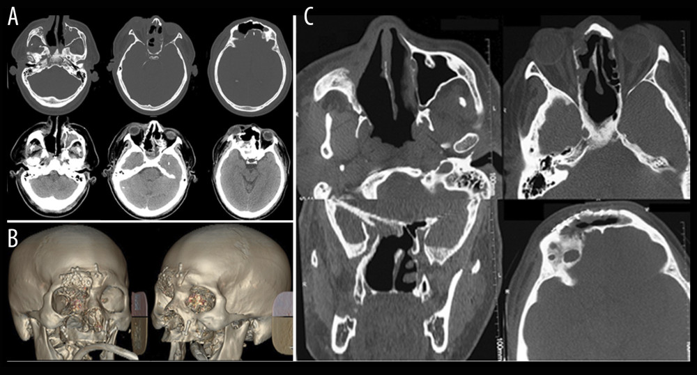 Radiographic images of post-surgery and follow-up. (A) Axial cross-section showing surgical gaps. (B) Volumetric reconstruction showing titanium plates used for the bone fixation. (C) Control CT made 6 months after the surgery. Axial cross-section and front cross-section showing solution of continuity of the wall bone of the right antrum maxillary, ethmoidal cells, sphenoidal, and frontal sinuses, as well as plates and metal screws of osteosynthesis.