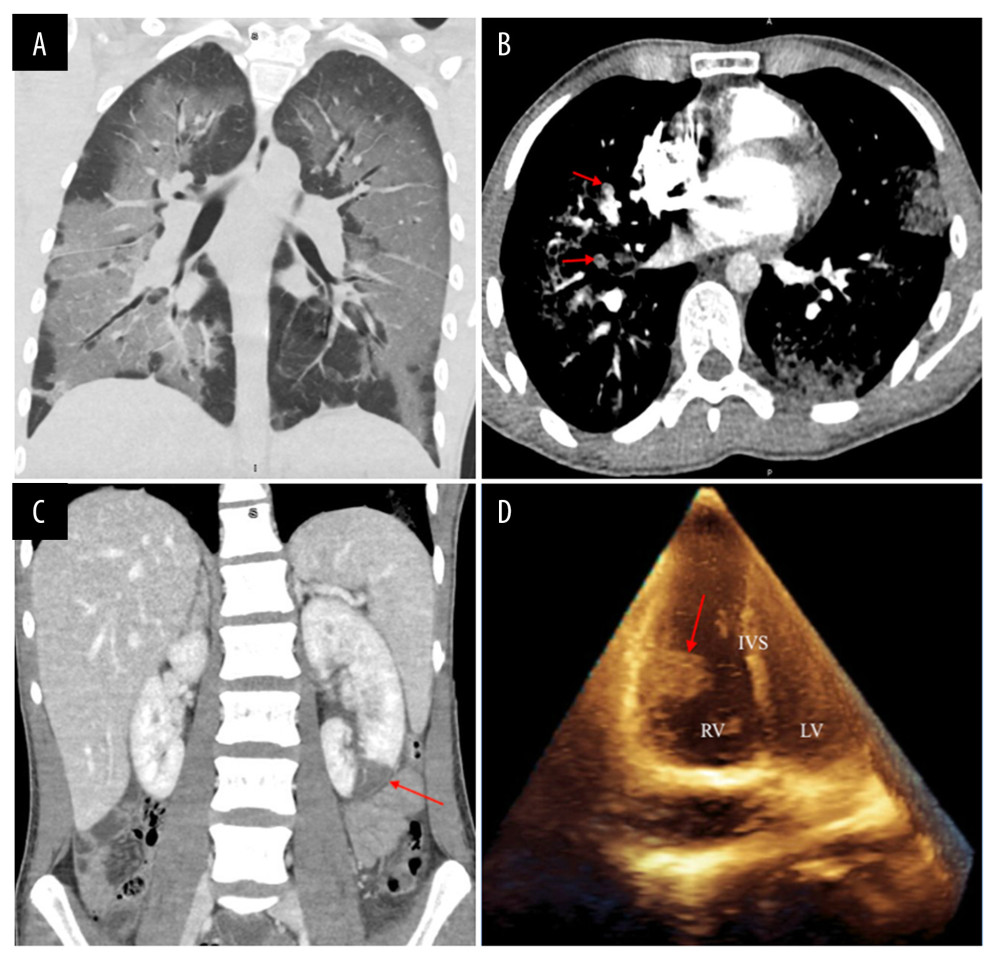 (A) Computed tomography of the chest demonstrating confluent bilateral ground-glass pulmonary opacities with septal thickening and relative subpleural sparing in a lower lobe-predominant distribution; (B) Computed tomography angiography of the chest demonstrating multiple bilateral pulmonary emboli (red arrows); (C) Computed tomography of the abdomen and pelvis demonstrating a large left renal infarct (red arrows); (D) Transthoracic echocardiogram demonstrating a large mobile mass on the free wall of the right ventricle (RV – right ventricle; LV – left ventricle; IVS – interventricular septum).