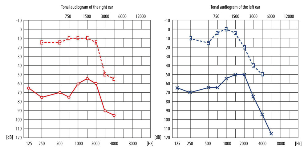 Pure tone audiometry result.