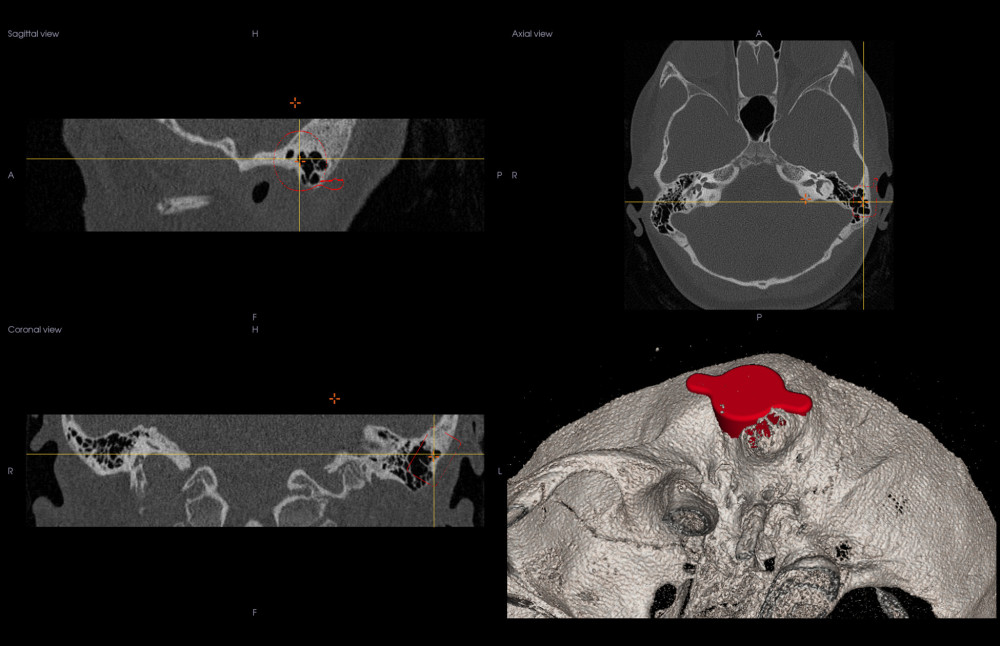 Computed tomography temporal bone assessment.