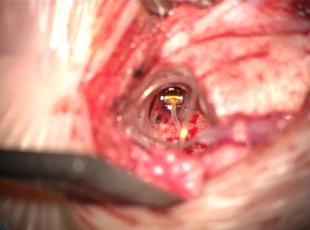 Method of attaching the Vibrant Soundbridge VORP 503 with the floating mass transducer and incus-SP-coupler in the temporal bone.