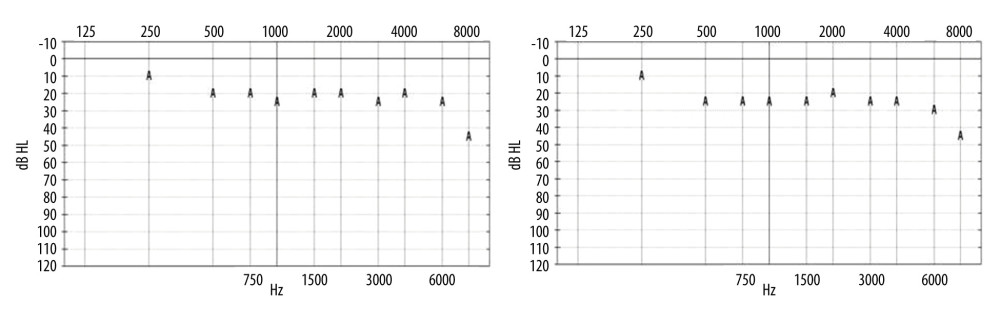 Free-field audiogram at 1- and 12-month follow-up.