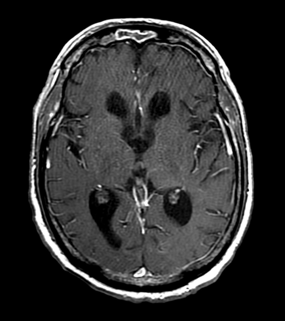Axial contrast-enhanced T1 image of the brain demonstrating normal appearance of the thalamus. No abnormal intracranial enhancement. Mild diffuse dural enhancement is within normal limits.