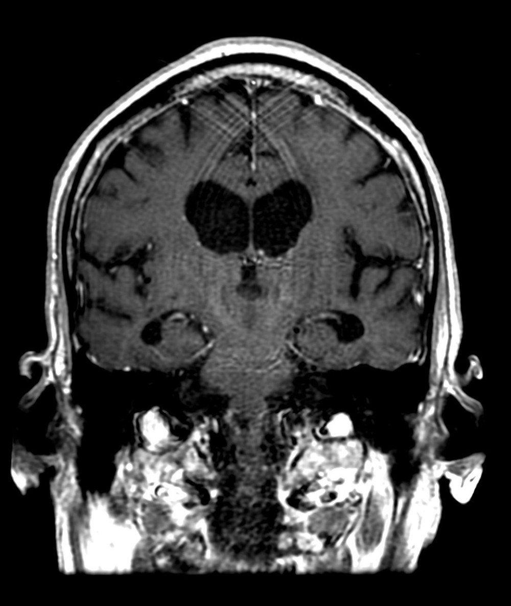 Coronal contrast-enhanced T1 image of the brain with normal appearance of the brain, thalamus, and brainstem.