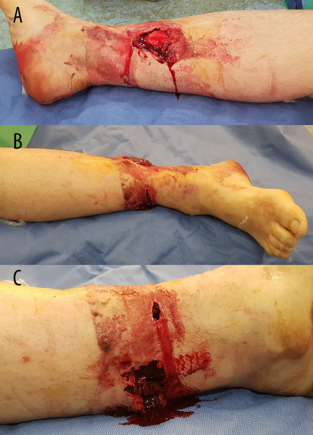 Images of the injured limb on admission. (A) The bone was exposed from the medial side, (B) Pale under the injury site and (C) Severe soft tissue injury of the lateral side.