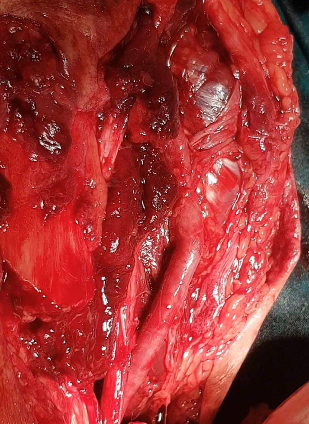 End-to-end bypass anastomosis of the posterior tibial artery using a 10-cm graft from the major saphenous vein of the ipsilateral thigh.