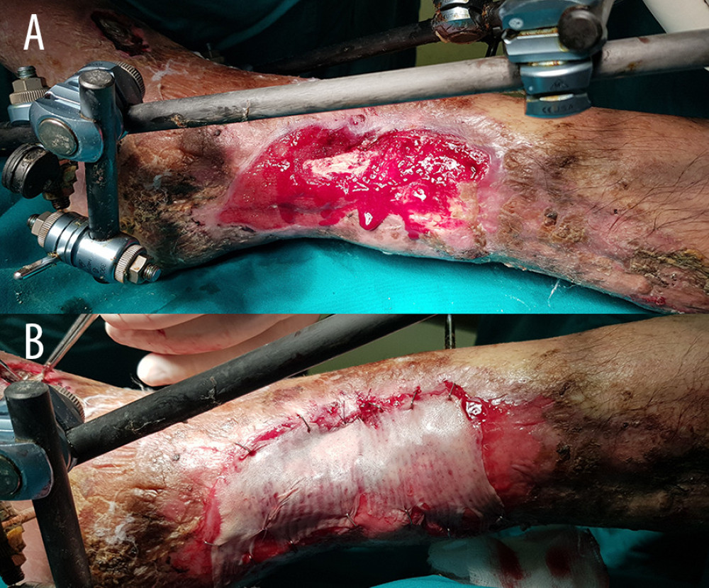 A split-thickness skin graft was used 1 month after the first operation. (A) Subcutaneous tissue with adequate blood supply. (B) Split-thickness skin graft.