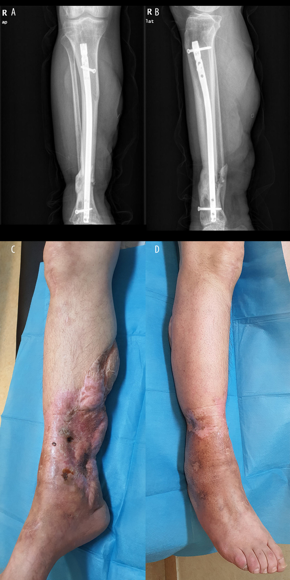 (A) Anteroposterior and (B) lateral X-ray of the leg 3 years after the injury. Note the closure of the bone gap and the fine consolidation of the free lateral bone fragment. (C) Medial and (D) lateral images of the leg.