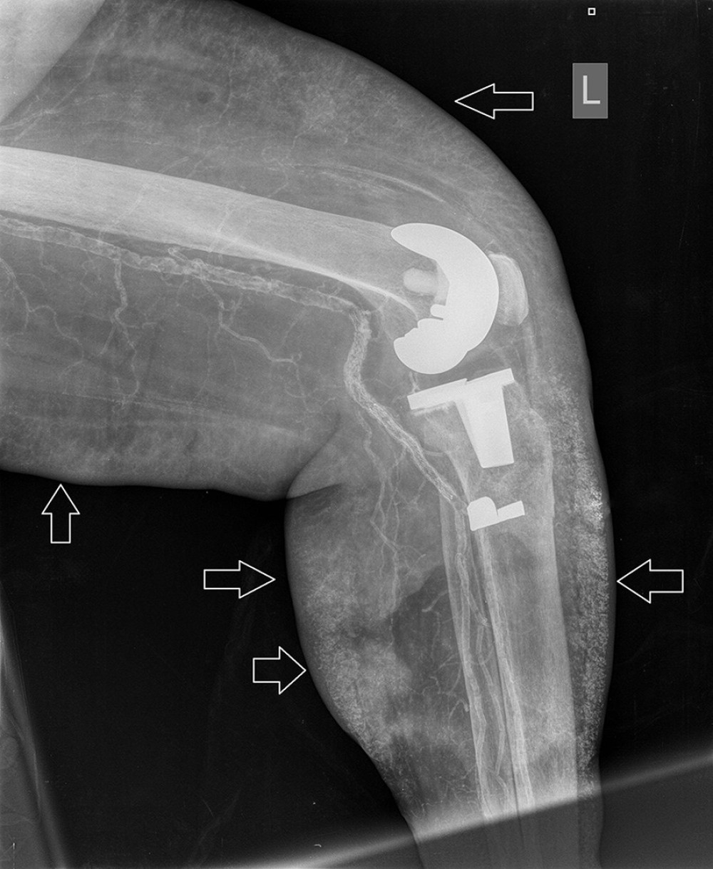 The X-ray of the lower left extremity showing massive subcutaneous calcifications (arrows).