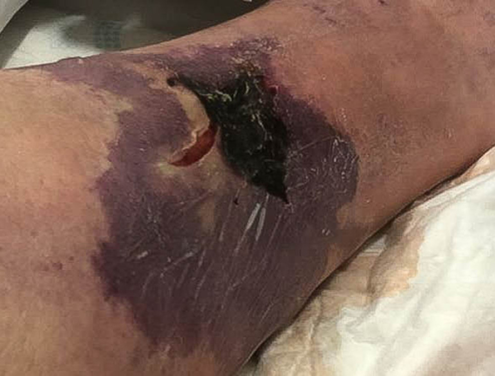 The necrotic skin lesions of the left leg.