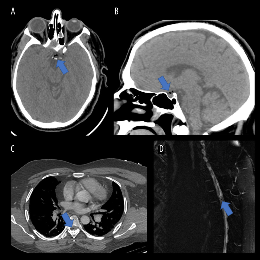 Initial trauma computed tomography (CT) scan. (A) Axial brain CT showing suprasellar air locules. (B) Sagittal brain CT showing suprasellar air locules. (C) Axial thoracic CT showing intradural air locule at the level of T3–T4. (D) Sagittal T2-weighted image showing a low signal intensity air locules at the level of T3–T4.