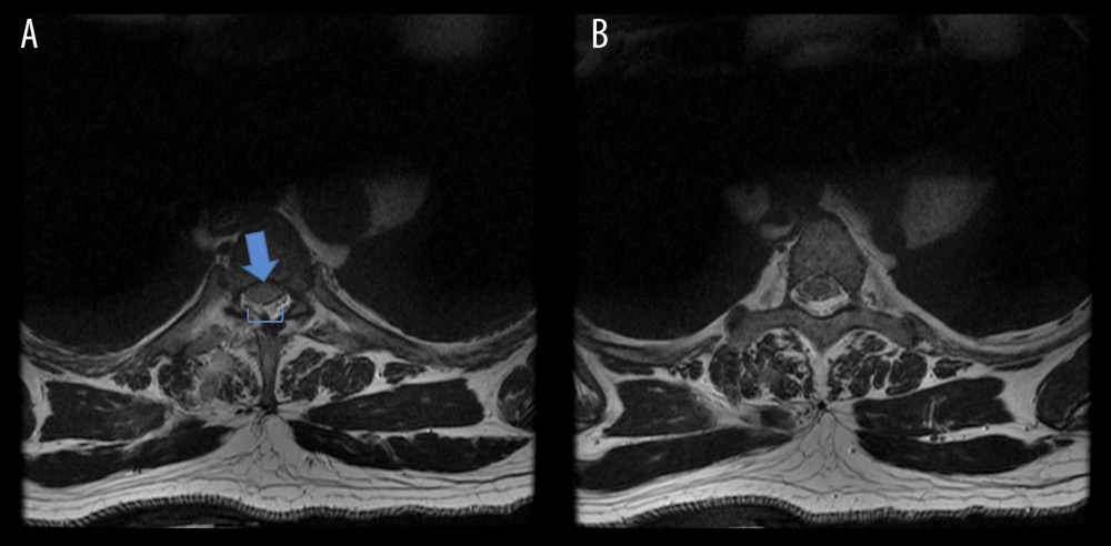 (A) Axial T2-weighted, non-fat-saturated image shows mild enlargement of the spinal cord at the level of injury with increased signal intensity, in keeping with the spinal cord contusion (blue arrow). A posterior dural sac defect was noted, in keeping with the dural tear (blue bracket). (B) The normal spinal cord above the level of injury is shown for comparison.
