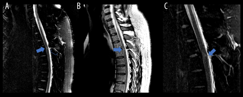 Thoracic magnetic resonance imaging (MRI). (A) Sagittal T2-weighted, fat-saturated image showing a focal spinal cord contusion at the level of T3–T4 (blue arrow) and interspinous ligamental injury with cerebrospinal fluid leak at the level of T3–T4 (blue bracket). (B) A sagittal T2-weighted non-fat-saturated image confirmed the focal spinal cord contusion at T3–T4 (blue arrow). (C) Magnified sagittal T2-weighted image showing a posterior dural defect measuring 0.4 cm, in keeping with a dural tear (blue arrow).