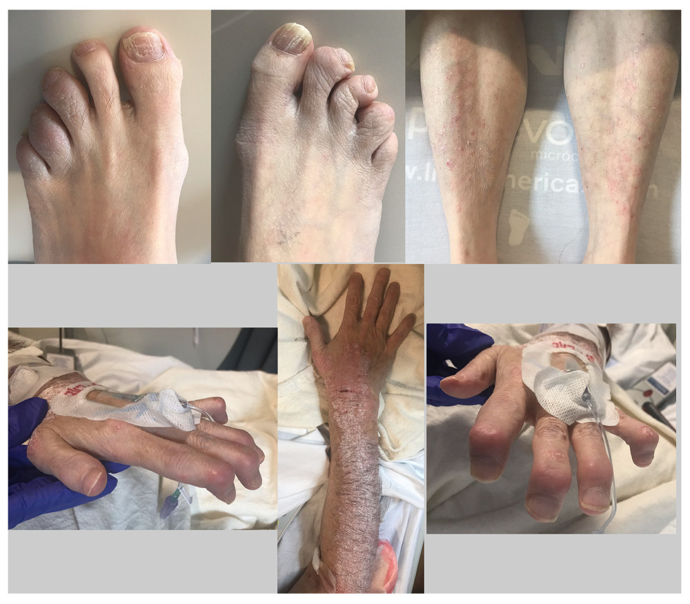 These images of our patient show swelling and enlargement of most of the distal interphalangeal joints in his hands and feet and significant flexed deformities in those joints. They also reveal onycholysis and a scaly, silvery, erythematous rash with sharply defined margins on his forearms, wrists, fingers, toes, and legs.