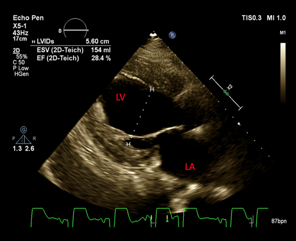 A transthoracic echocardiogram reveals severely reduced left ventricular systolic function, severe diastolic dysfunction, and severe global hypokinesis.
