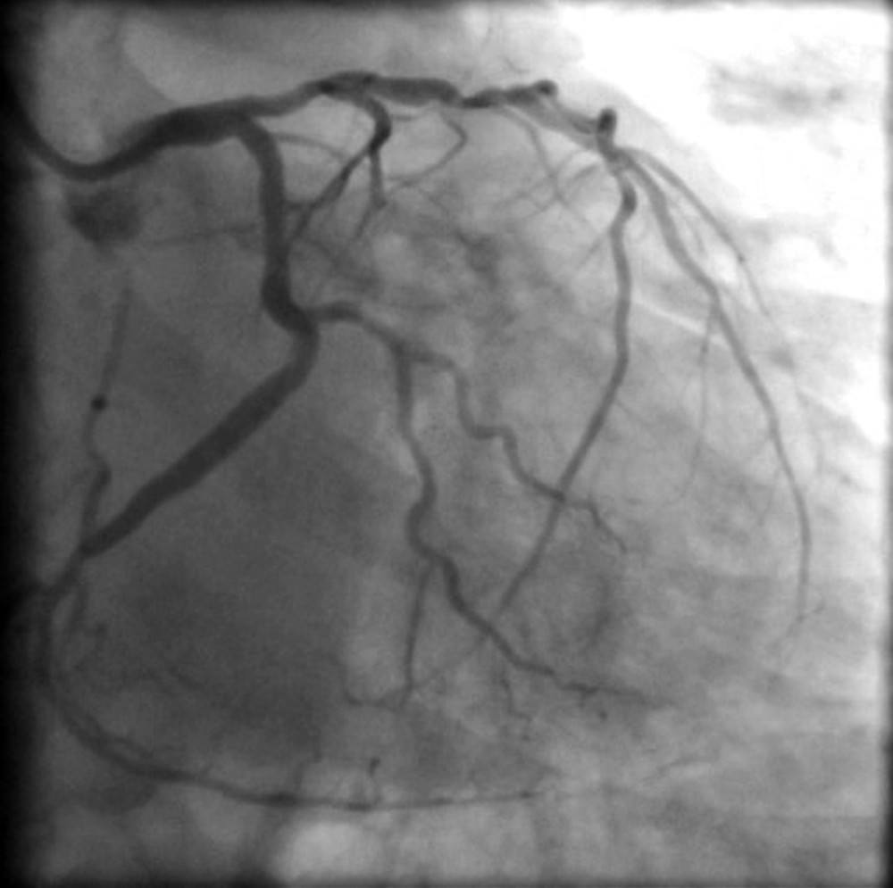 Coronarography of the left coronary artery.