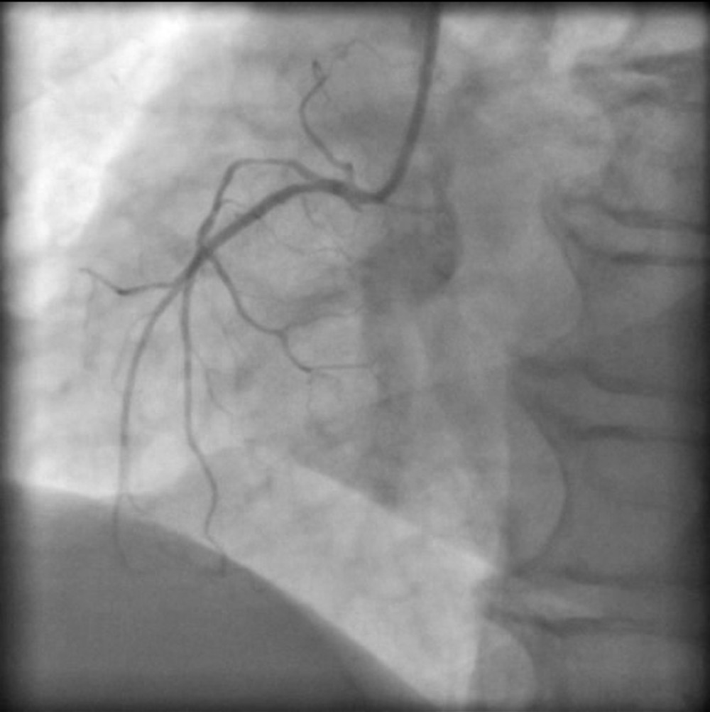 Coronarography of the right coronary artery.