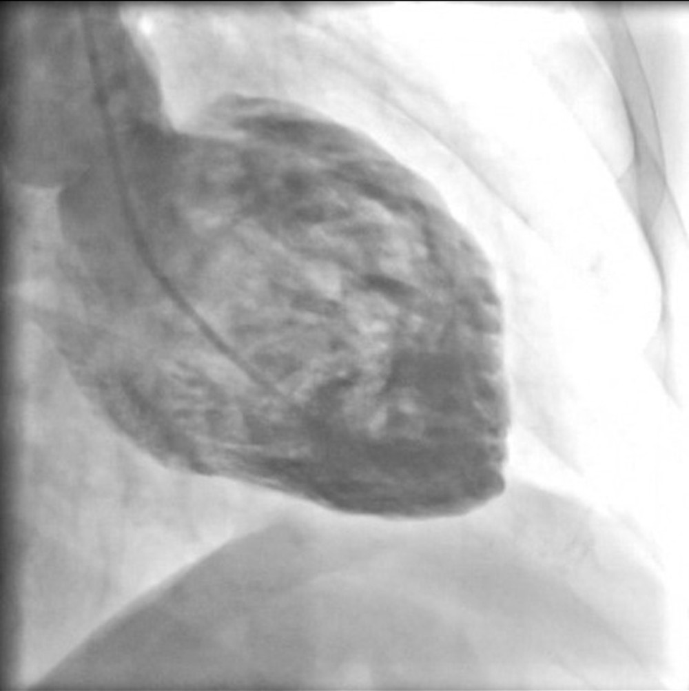 Ventriculography – left ventricular diastole.