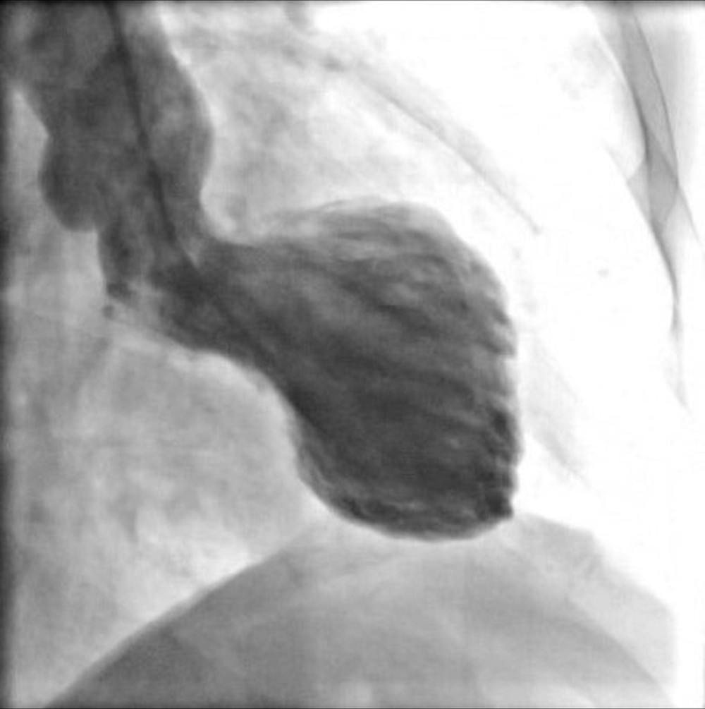 Ventriculography – left ventricular contraction (akinesia of the apex, apical, and mid-segments of the left ventricle wall).