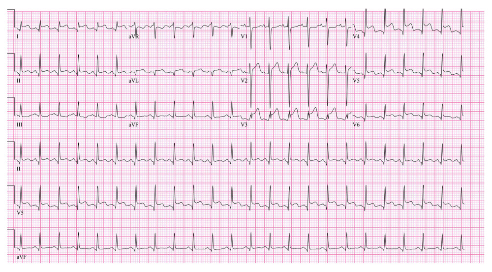 Electrocardiogram (EKG) while the patient experienced tachycardia without chest pain. EKG demonstrated sinus tachycardia with diffuse ST-segment elevations that were most prominent in the anteroseptal leads. These findings were concerning for ischemia versus pericarditis versus myocarditis.