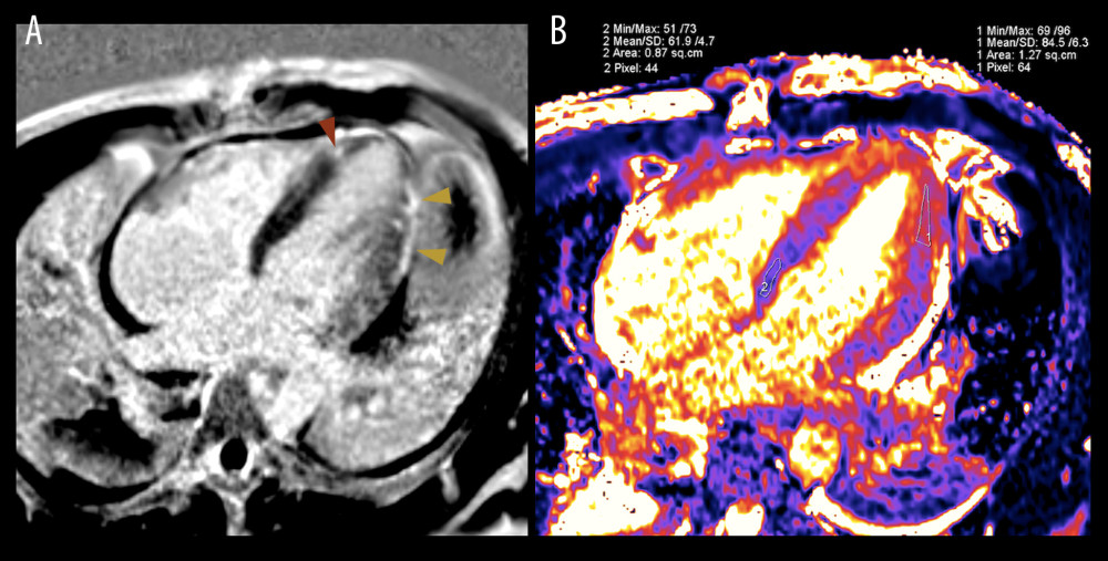 Cardiovascular magnetic resonance (CMR) demonstrates myocardial changes that reveal the diagnosis. (A) Late gadolinium enhancement CMR revealed acute myocarditis as evidenced by epicardial necrosis and edema of the middle and apical lateral wall (yellow arrowheads), as well as small foci of mid-myocardial necrosis in the apical septum (red arrowheads). (B) Direct T2 quantification confirmed the presence of myocardial edema indicative of acute ischemia in these regions, measuring 84.5±6.3 ms (Region 1), compared with 61.9±4.7 ms in healthy non-ischemic myocardium (Region 2). These findings support the diagnosis of clozapine-induced myocarditis.