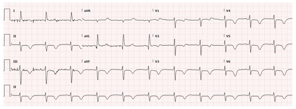 Repeat electrocardiogram showing diffuse symmetric T-wave inversions precordially with biphasic T waves noted in V1 and V2 with associated minimal ST depression inferiorly in leads II, III, and aVF in addition to incomplete R wave progression consistent with combined types A and B Wellens patterns.