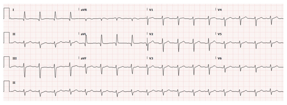 Repeat electrocardiograms after non-ST segment elevation myocardial infarction therapy demonstrating resolution of the deep T-wave inversions and ST depressions.