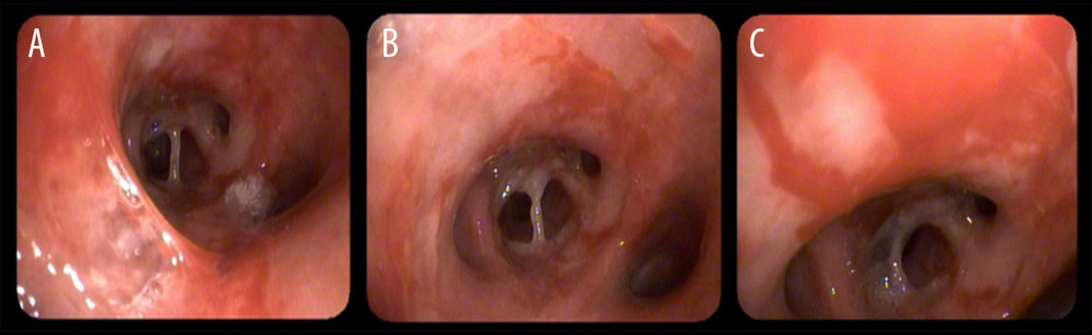 (A) The bronchoscopic image showed a cavitary area.(B) The bronchoscopic image showed hemorrhagic stitches. (C) The bronchoscopic image showed an active bleeding area.