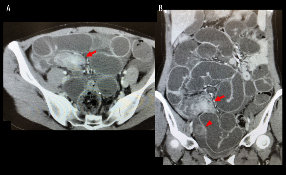 (A, B) Contrast-enhanced computed tomography (CT) findings. Abdominal contrast-enhanced CT revealed a heterogeneously enhanced lesion with cystic content, which measured approximately 50×25×35 mm (arrowhead). The caliber change of the ileum at the same site and dilated small bowel proximal to the caliber change were observed. No dilated lymph nodes were found. A polycystic lesion was found in the right ovary, confirming the previously diagnosed right chocolate cyst (arrow head). No other intrapelvic lesion or ascites was detected.