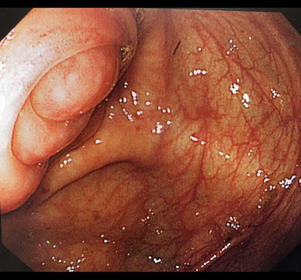 Colonoscopy findings. Colonoscopy showed no epithelial lesion in the terminal ileum and the cecum, but the ileocecal valve and the lumen of the terminal ileum seemed to be rather protruded inward, suggesting compression by the extramural lesion. The appendiceal orifice could not be discerned.