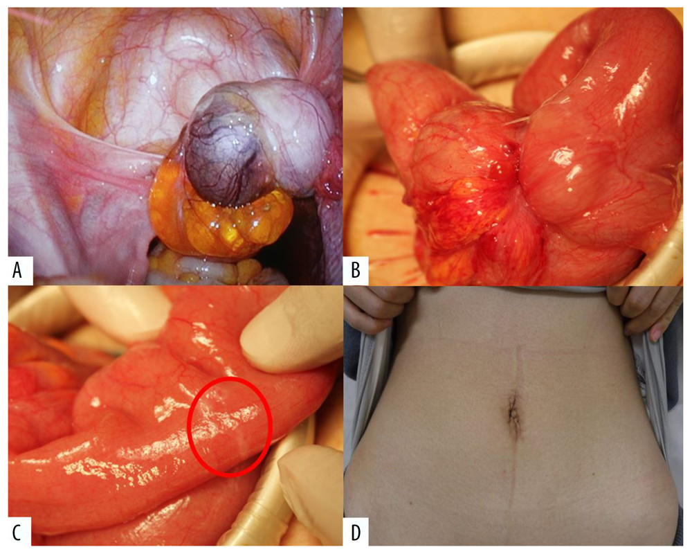 Intraoperative findings. The right ovary was enlarged. No other abnormalities were observed in the pelvis (A). The lesion responsible for the bowel obstruction was located at the terminal ileum, forming a solid mass (B). The small white lesion was attached to the serosa (C), which was resected together with the mass. The abdominal scar was minimal and aesthetically satisfactory (D).