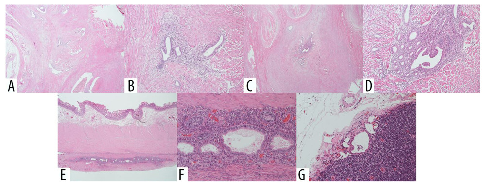 Histopathological findings. In the ileum (A, B) and appendix (C, D), gland formation having similarity with tissues of the endometrial glands and interstitium in the muscularis propria and subserosa was observed. The white scar on the serosa of the ileum (E, F) and the picked-up lymph nodes (G) showed similar findings (hematoxylin and eosin staining: A, C, E: ×20; B, D, F, G: ×100).
