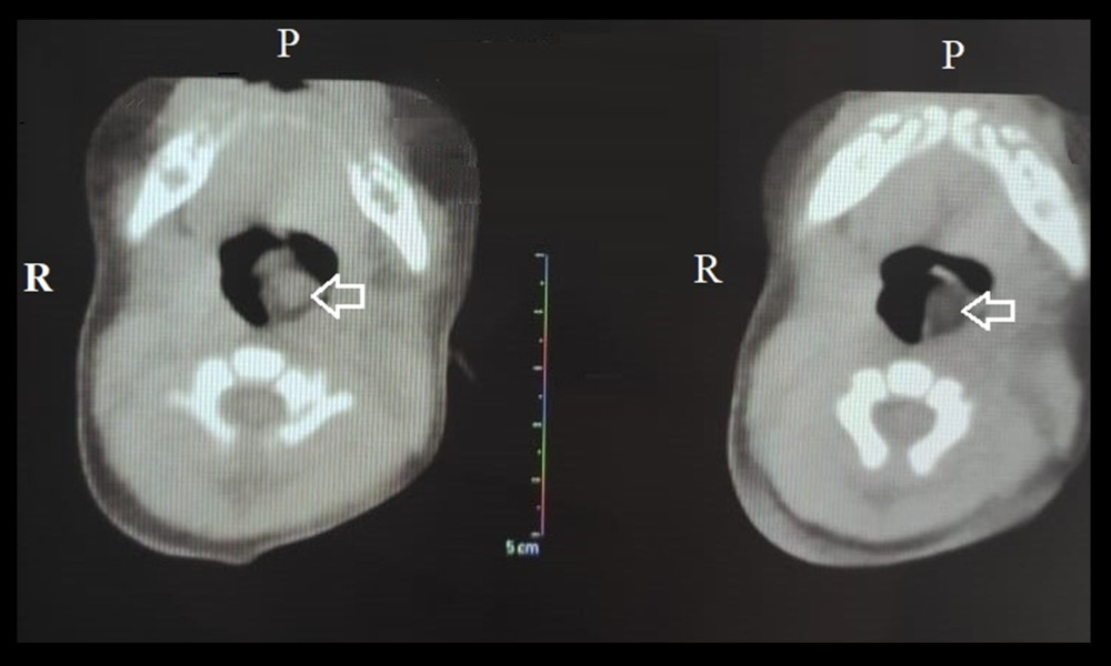 Computed tomography (CT) scan of the hairy polyp originating from the soft palate (indicated by arrow) obstructs the neonate’s oropharynx.