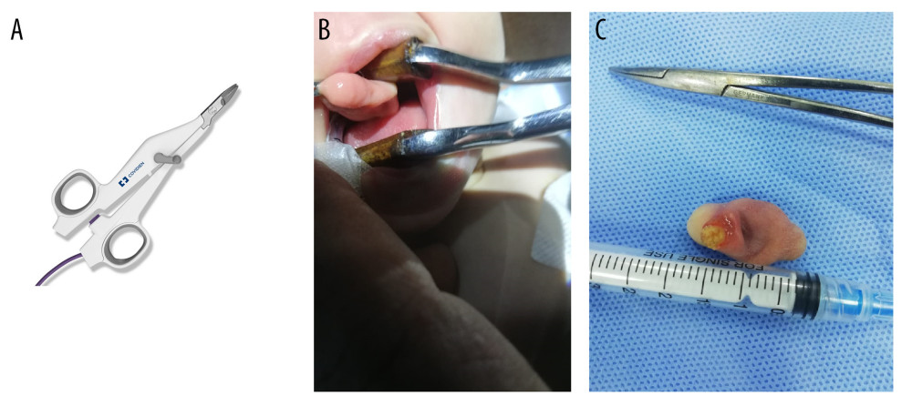 (A) The used the Covidien LigaSure device to excise the mass. (B) The hairy polyp being pulled out of the mouth before excision. (C) The polypoid mass of hairy polyp after the excision, measuring 3×2 cm.