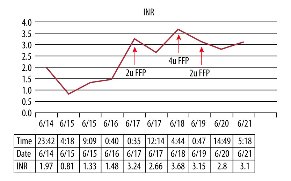 INR results and FFP transfusion during the perioperative period. Note the elevated INR despite transfusion of 8 units of FFP in the absence of bleeding.