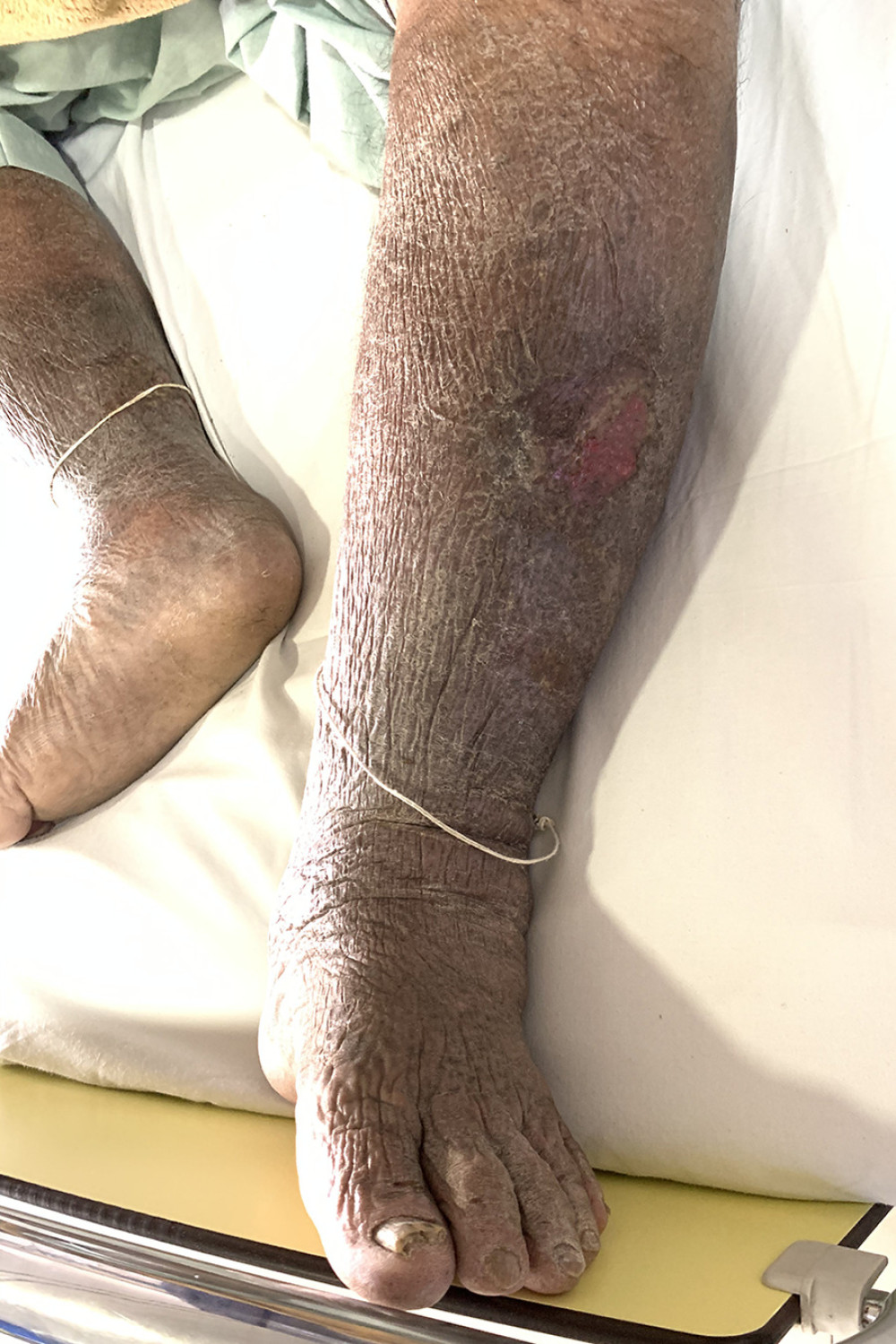 Numerous verrucous folds and cobblestone-like nodules, and plaques and a painless ulcer on the left leg.
