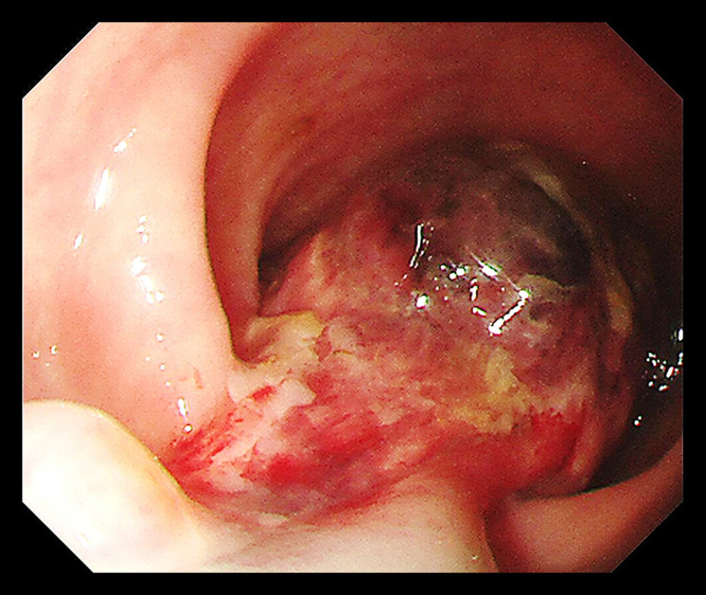 At colonoscopy, a pedunculated polyp measuring approximately 4 cm is found in the rectum.